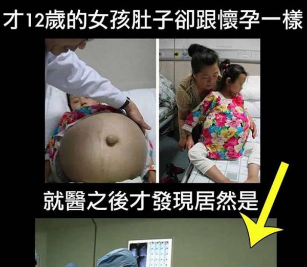 12歲女孩體內長巨大腫瘤體型瘦小腫瘤竟重30斤