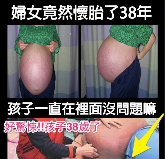 女怕動手術懷孕長達38年！網友：竟然不會自己掉下來！