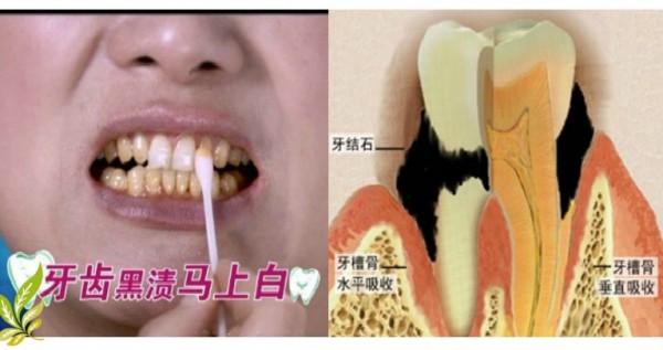 黃牙齒有救了！5分鐘居然就把整年累積的黃牙垢都去除了！牙齒變得又白又乾淨阿！這麼好的方法怎麼現在才知道？