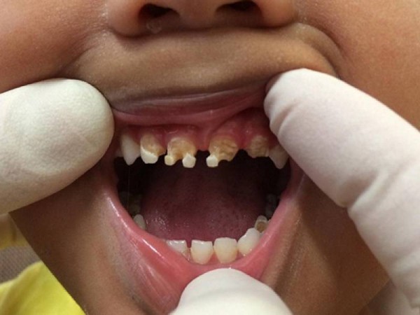 5 歲男孩乳牙全毀，可能造成永久缺牙，凶手竟然是全球大受歡迎的「這個」...